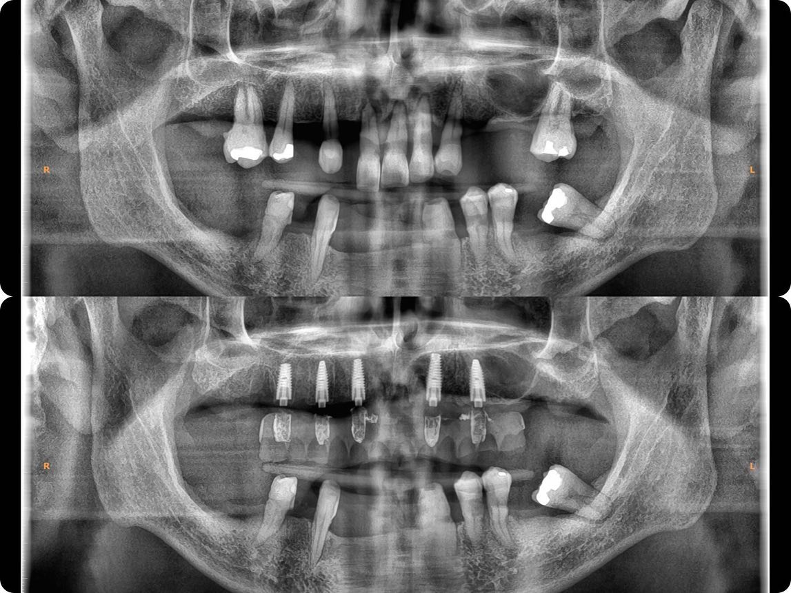 PRecios de implantes dentales en bogota