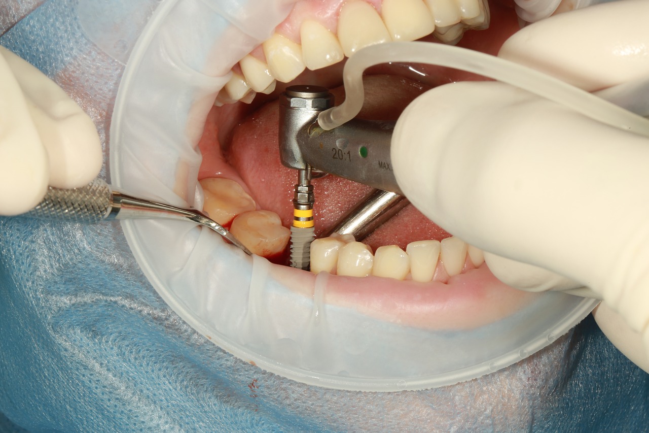 Factores que influyen en precios de implantes dentales en bogota