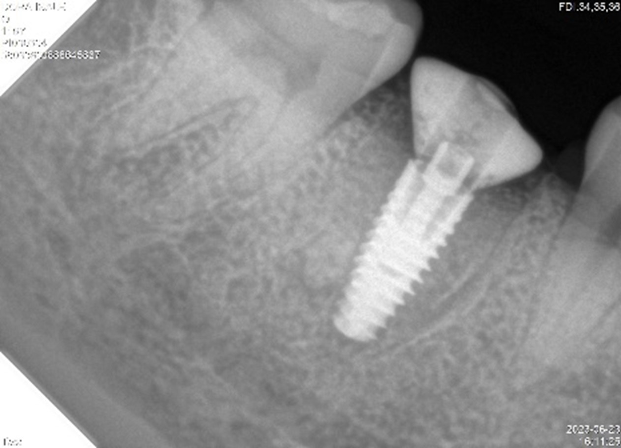 Implantes dentales en el mismo día