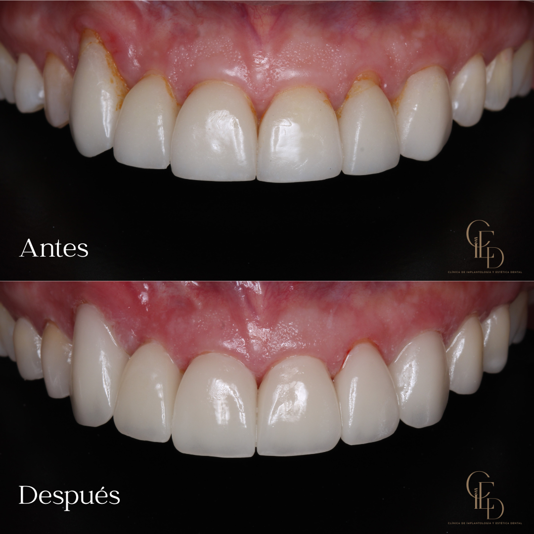 Precio de diseño de sonrisa en Bogota