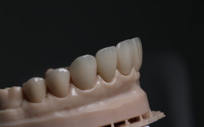 Carillas Dentales en Bogotá. Tipos, Beneficios y Cuidados para una Sonrisa Perfecta